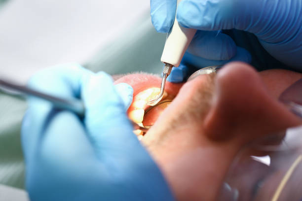 Best Emergency Treatment for Dental Infections or Abscesses in Northgate, OH